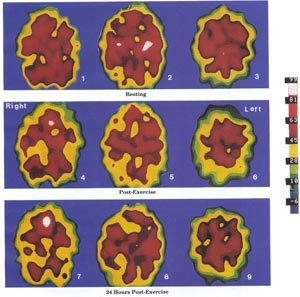 These Xenon SPECT scans show pathological brain changes in a 37 year-old female M.E. patient.